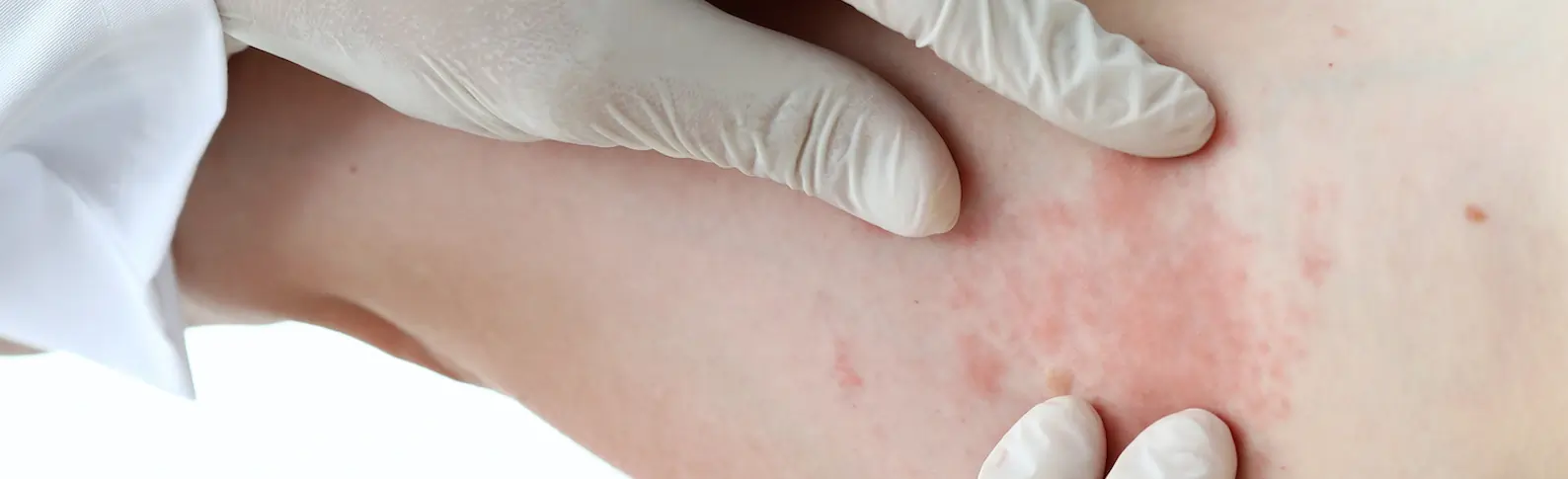 Kann Schimmel in der Wohnung zu Hautpilz führen?